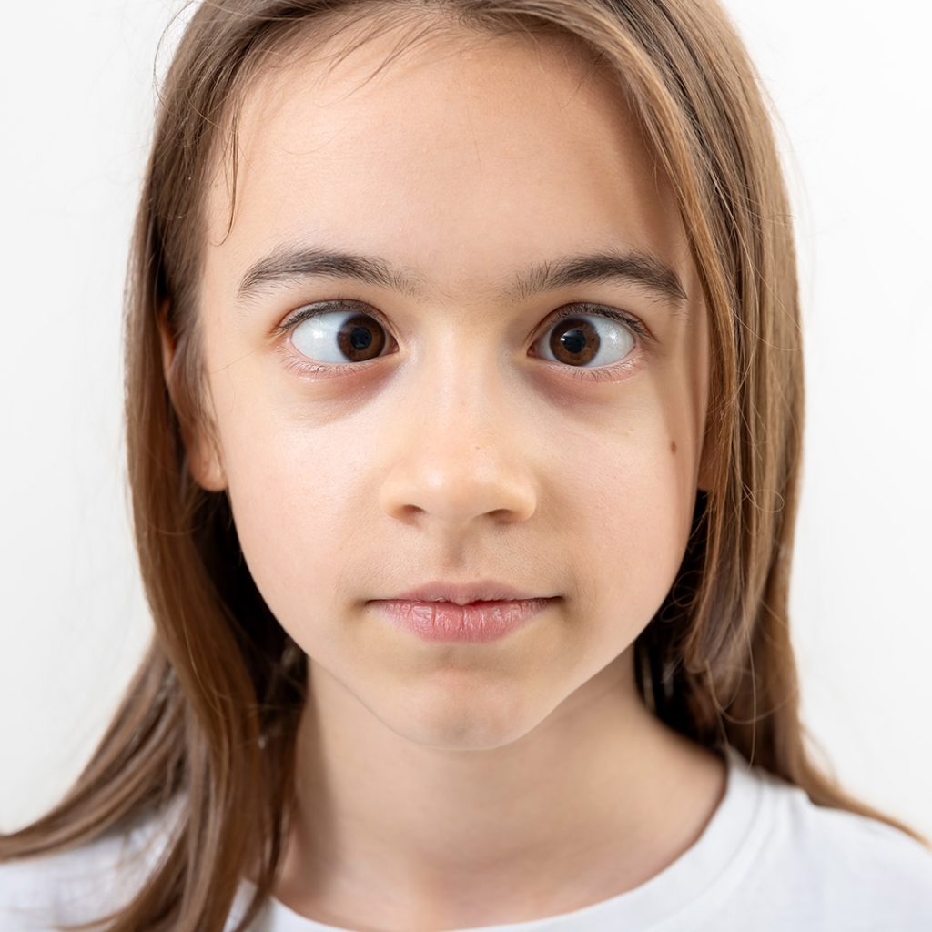strabism pediatric grigoras operatie sau corectie optica